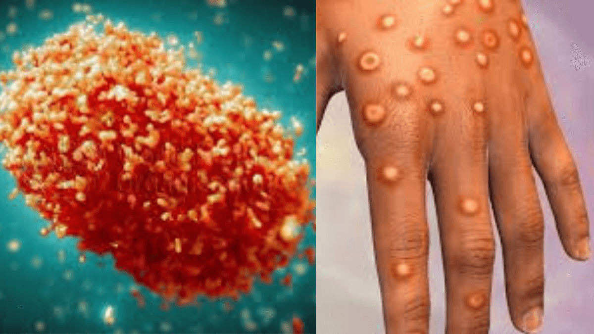 MPOX मंकीपॉक्स का प्रकोप: कैसे होती है पहचान, क्या है बचाव